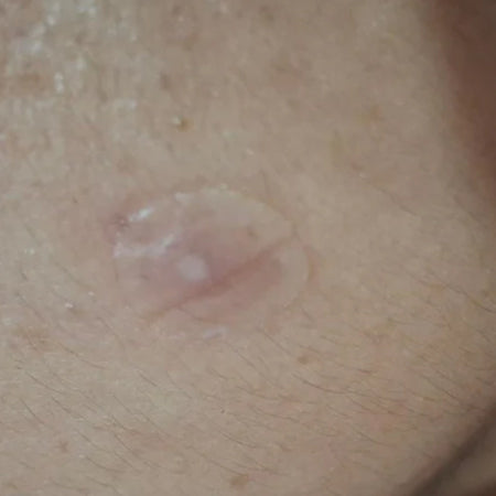 Sumak Skin